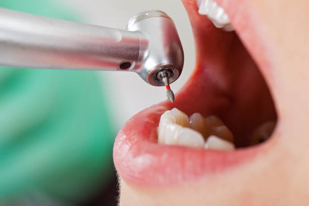 Best Emergency Dentist for Knocked-Out Tooth in Burbank, CA